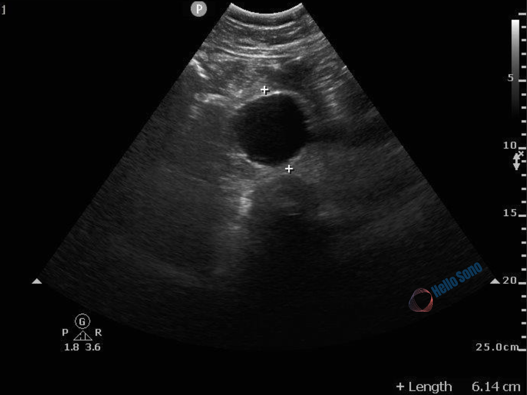 Abdominal Aortic Aneurysm Screening: How Point-of-Care Ultrasound